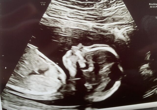 FN advarer: Krigen i Ukraine sætter gravide i fare