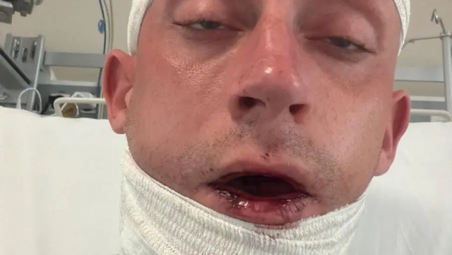 Bro brutalt tæsket: Nu deles nyt billede